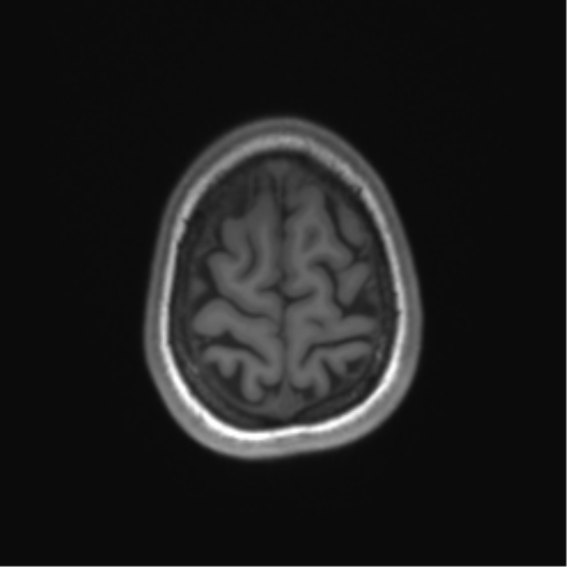 Cerebellar agenesis with hypoplastic pons (pontocerebellar hypoplasia) (Radiopaedia 57224-64138 Axial T1 68).png