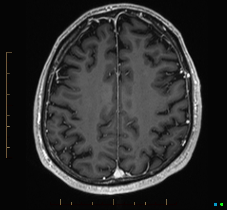 Cerebellar gangliocytoma (Radiopaedia 65377-74422 Axial T1 C+ 101).jpg