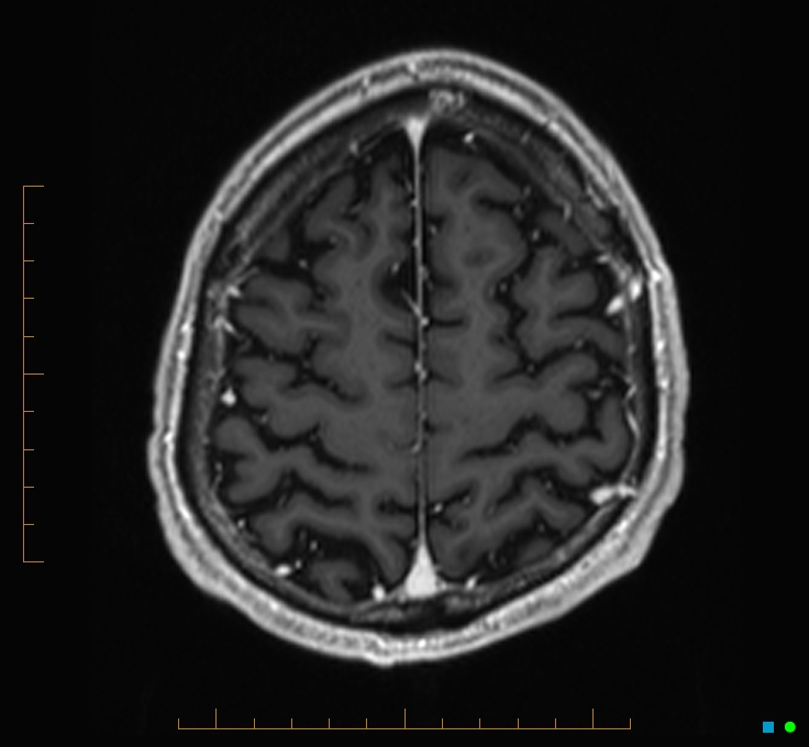 Cerebellar gangliocytoma (Radiopaedia 65377-74422 Axial T1 C+ 118).jpg