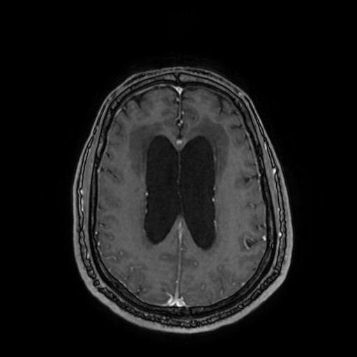 Cerebellar hemangioblastoma (Radiopaedia 88055-104622 Axial T1 C+ 120).jpg