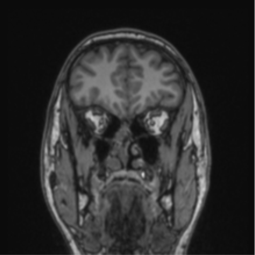 Cerebellar hemangioblastomas and pituitary adenoma (Radiopaedia 85490-101176 Coronal T1 70).png