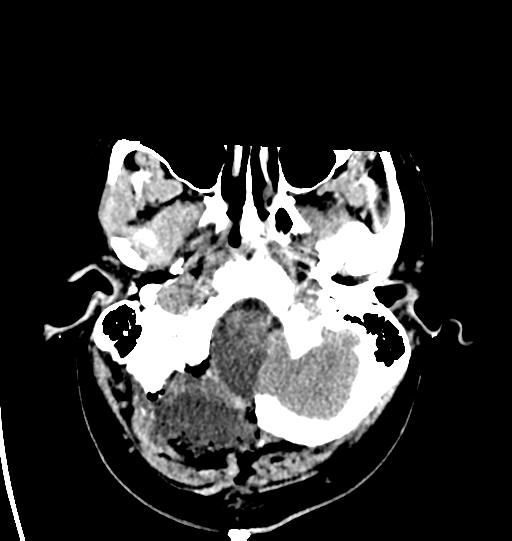 File:Cerebellar infarct due to vertebral artery dissection with posterior fossa decompression (Radiopaedia 82779-97031 Axial non-contrast 5).png
