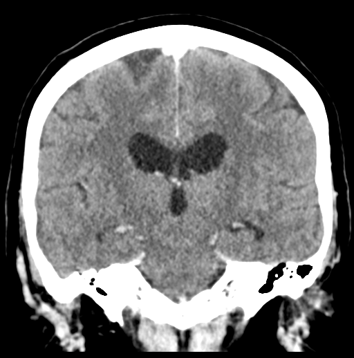 Cerebellar metastasis (Radiopaedia 54578-60812 Coronal C+ 32).png