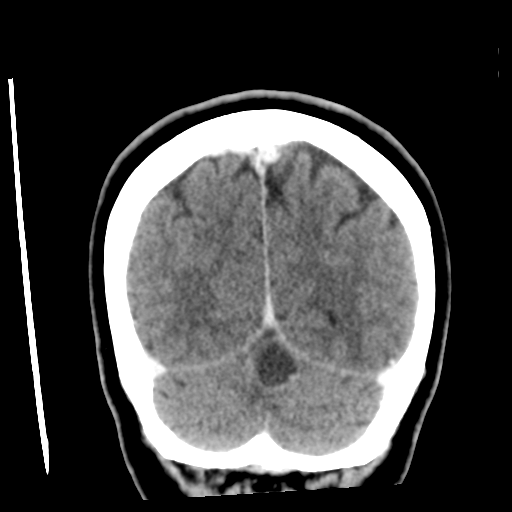 Cerebellar metastasis (cystic appearance) (Radiopaedia 41395-44258 D 49).png