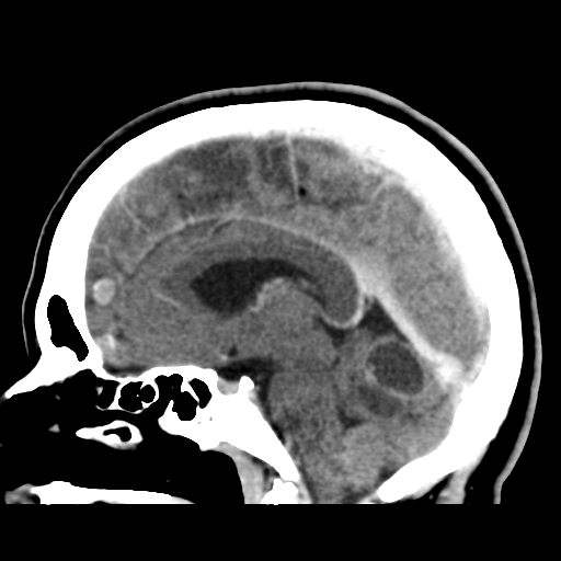 Cerebellar metastasis (cystic appearance) (Radiopaedia 41395-44258 F 28).png