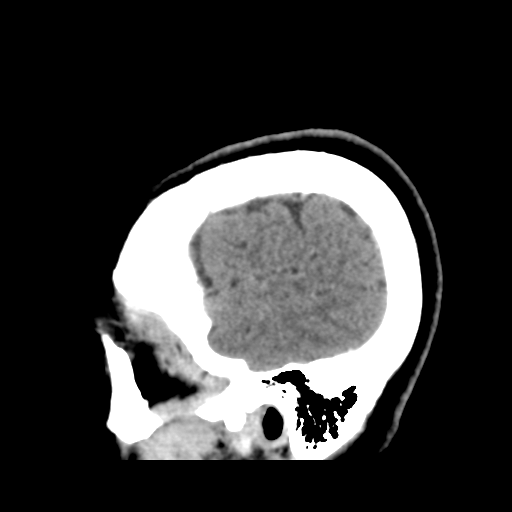 Cerebellar metastasis (cystic appearance) (Radiopaedia 41395-44258 F 45).png