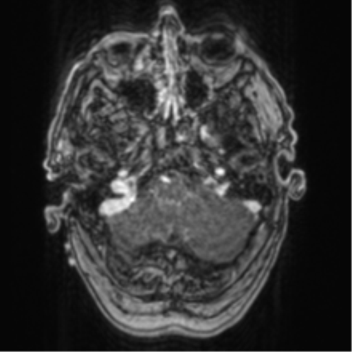 Cerebellar metastasis from lung adenocarcinoma (Radiopaedia 86690-102829 Axial T1 C+ 16).png