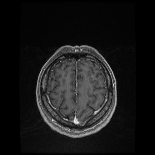 Cerebellar metastasis of pulmonary adenocarcinoma, cavernous venous malformation, and developmental venous anomaly (Radiopaedia 85827-101661 Axial T1 C+ 76).jpg