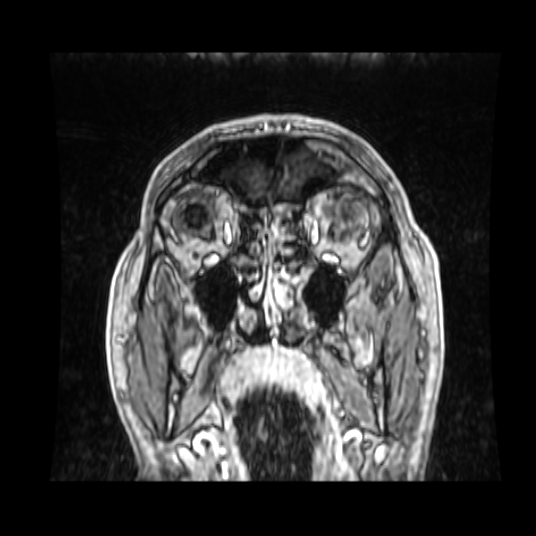 Cerebellar metastasis of pulmonary adenocarcinoma, cavernous venous malformation, and developmental venous anomaly (Radiopaedia 85827-101661 Coronal T1 C+ 81).jpg