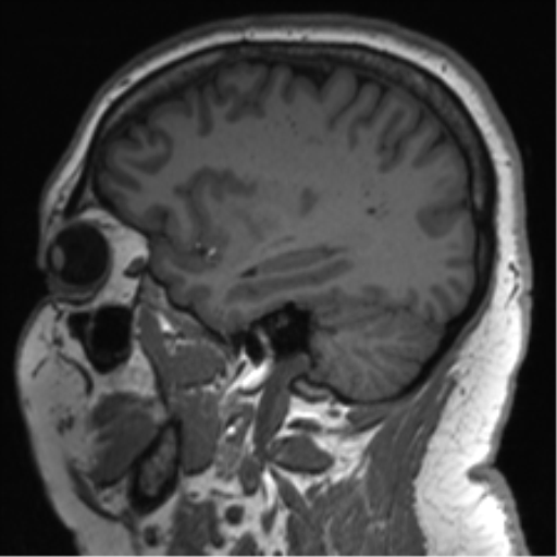 Cerebellopontine angle meningioma (Radiopaedia 48434-53348 Sagittal T1 64).png