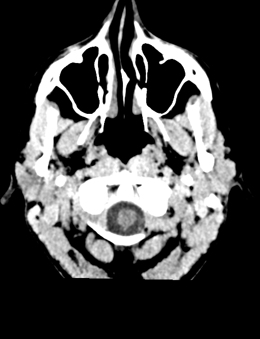 Cerebral abscess (Radiopaedia 60342-68008 Axial non-contrast 3).png