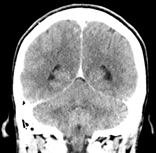 Cerebral abscess (Radiopaedia 60342-68008 Coronal C+ delayed 47).png