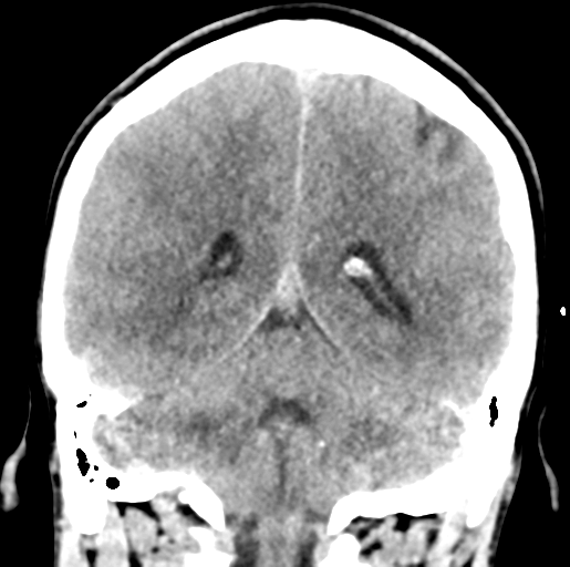 Cerebral abscess (Radiopaedia 60342-68008 Coronal non-contrast 43).png
