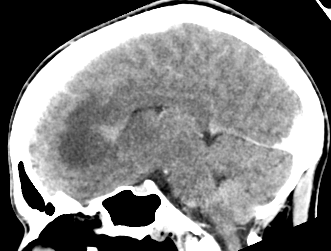 Cerebral abscess (Radiopaedia 60342-68008 Sagittal C+ delayed 27).png