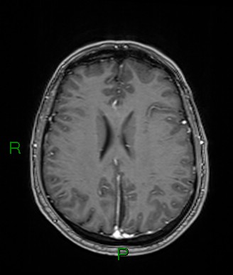 Cerebral abscess and subdural empyema (Radiopaedia 84436-99779 Axial T1 C+ 34).jpg
