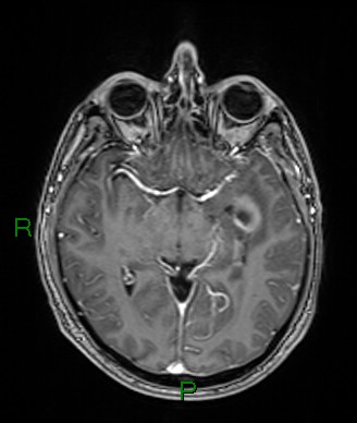 File:Cerebral abscess and subdural empyema (Radiopaedia 84436-99779 Axial T1 C+ 49).jpg