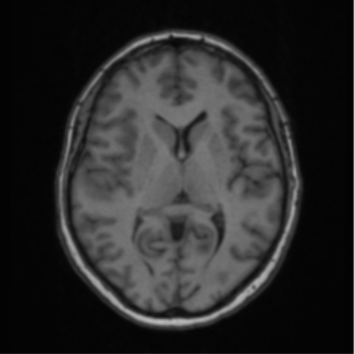 File:Cerebral abscess from pulmonary arteriovenous malformation (Radiopaedia 86275-102291 Axial T1 40).png