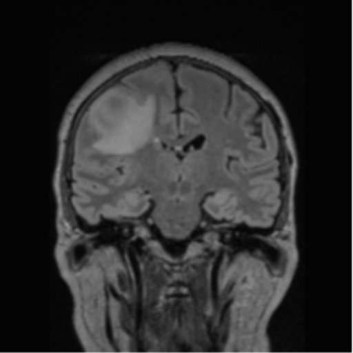 Cerebral abscess from pulmonary arteriovenous malformation (Radiopaedia 86275-102291 Coronal FLAIR 44).png