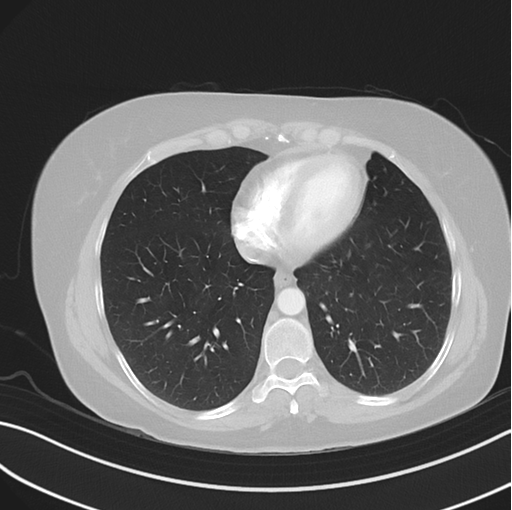 Cerebral abscess from pulmonary arteriovenous malformation (Radiopaedia 86275-102292 Axial lung window 42).png