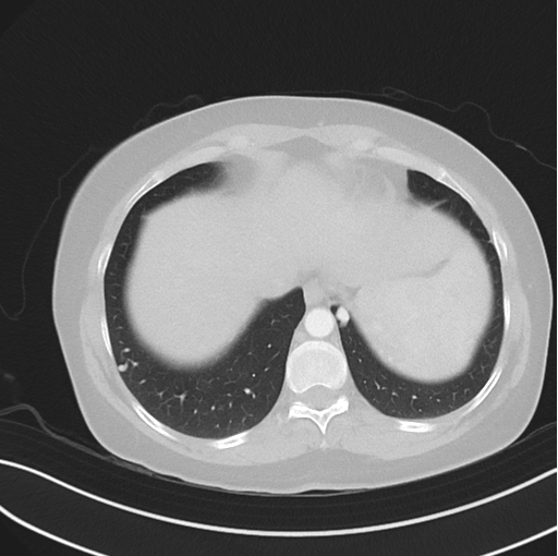 Cerebral abscess from pulmonary arteriovenous malformation (Radiopaedia 86275-102292 Axial lung window 48).png