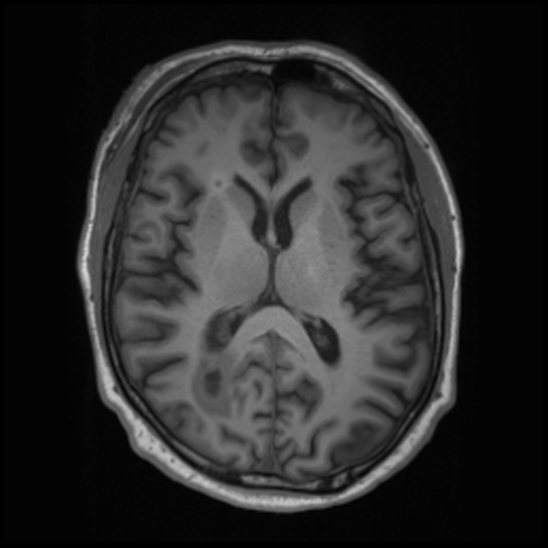 File:Cerebral abscess with ventriculitis (Radiopaedia 78965-91878 Axial T1 27).jpg