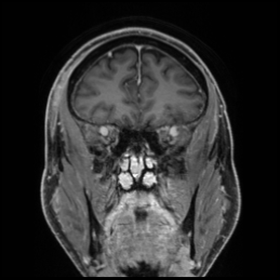 Cerebral abscess with ventriculitis (Radiopaedia 78965-91878 Coronal T1 C+ 19).jpg