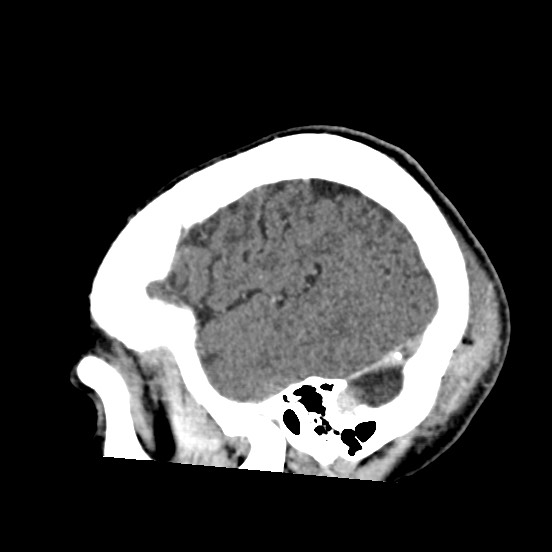 Cerebral amyloid angiopathy-related inflammation (Radiopaedia 74836-85848 C 50).jpg