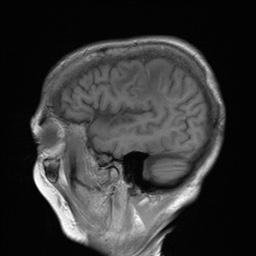File:Cerebral amyloid angiopathy-related inflammation (Radiopaedia 74836-85849 Sagittal T1 9).jpg