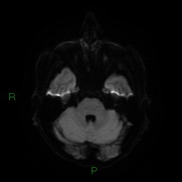 File:Cerebral amyloid angiopathy (Radiopaedia 77506-89664 Axial DWI 9).jpg