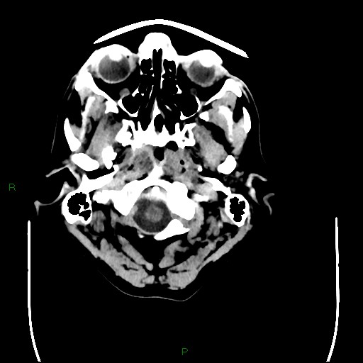 Cerebral amyloid angiopathy (Radiopaedia 77506-89665 Axial non-contrast 7).jpg