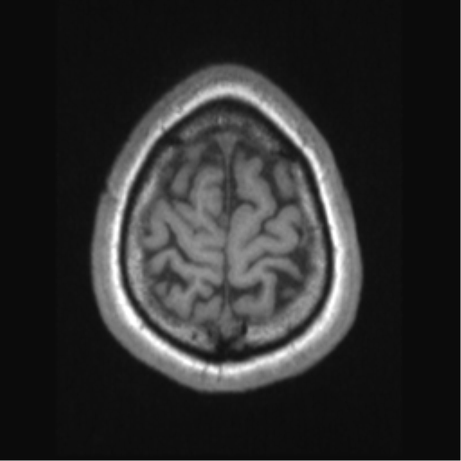 Cerebral arteriovenous malformation (Radiopaedia 39259-41506 Axial T1 69).png