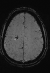 File:Cerebral arteriovenous malformation (Radiopaedia 55798-62372 Axial SWI 31).png