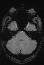 File:Cerebral arteriovenous malformation (Radiopaedia 55798-62372 Axial SWI 9).png