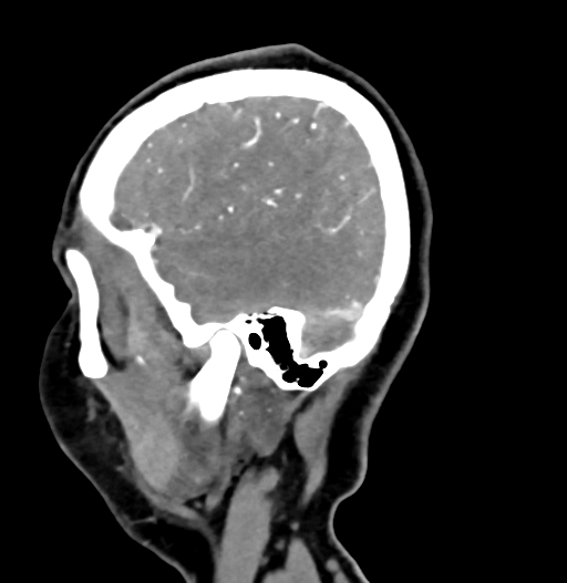 Cerebral arteriovenous malformation (Radiopaedia 73830-84645 D 77).jpg