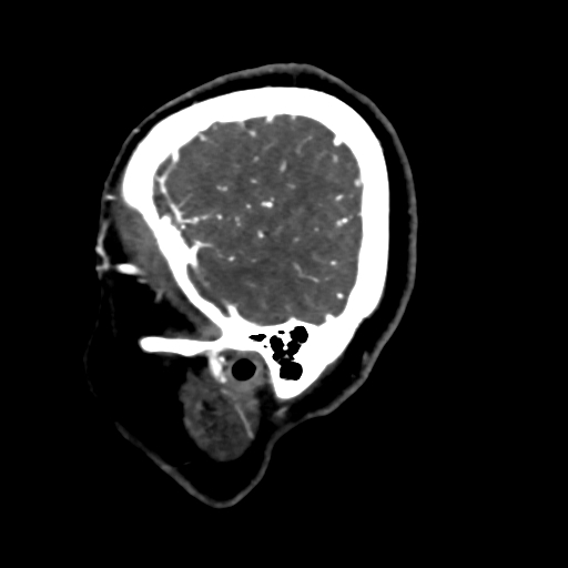 Cerebral arteriovenous malformation (Radiopaedia 73830-84645 Sagittal C+ delayed 10).jpg