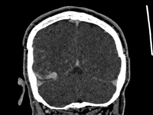 Cerebral arteriovenous malformation (Radiopaedia 78188-90746 Coronal C+ delayed 101).jpg