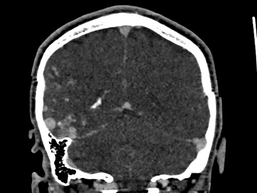 Cerebral arteriovenous malformation (Radiopaedia 78188-90746 Coronal C+ delayed 87).jpg