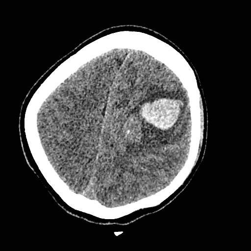Cerebral arteriovenous malformation (Radiopaedia 79677-92887 Axial non-contrast 33).jpg