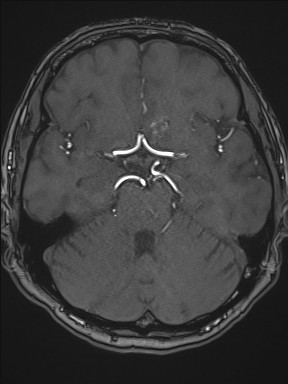 Cerebral arteriovenous malformation (Radiopaedia 84015-99245 Axial TOF 99).jpg