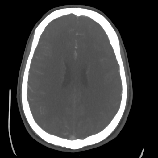 Cerebral arteriovenous malformation (Spetzler-Martin grade 2) (Radiopaedia 41262-44076 E 35).png