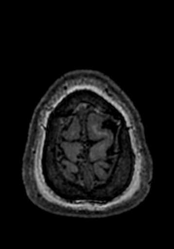 File:Cerebral arteriovenous malformation at posterior body of corpus callosum (Radiopaedia 74111-84925 Axial T1 3).jpg