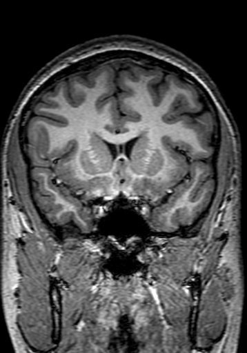 File:Cerebral arteriovenous malformation at posterior body of corpus callosum (Radiopaedia 74111-84925 Coronal T1 110).jpg