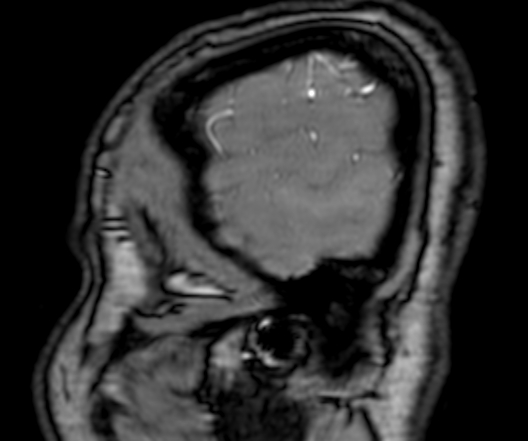 File:Cerebral arteriovenous malformation at posterior body of corpus callosum (Radiopaedia 74111-84925 J 3).jpg