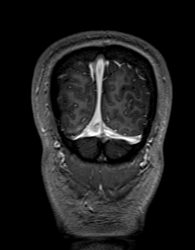 Cerebral arteriovenous malformation at posterior body of corpus callosum (Radiopaedia 74111-84925 K 345).jpg
