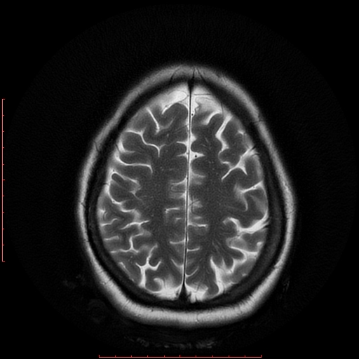 File:Cerebral cavernous malformation (Radiopaedia 26177-26306 Axial T2 17).jpg