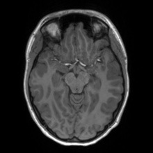 Cerebral cavernous venous malformation (Radiopaedia 70008-80021 Axial T1 29).jpg