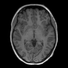 Cerebral cavernous venous malformation (Radiopaedia 70008-80021 Axial T1 34).jpg