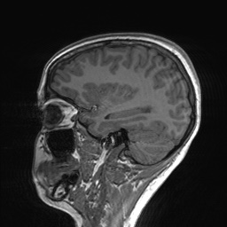 File:Cerebral cavernous venous malformation (Radiopaedia 70008-80021 Sagittal T1 53).jpg