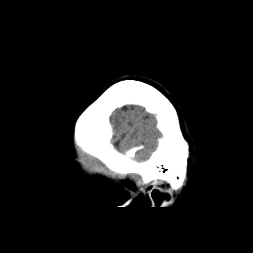 File:Cerebral cavernous venous malformation (Radiopaedia 70008-80022 C 54).jpg