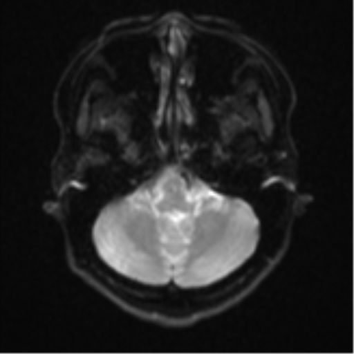 Cerebral cavernous venous malformations (Radiopaedia 48117-52946 Axial DWI 5).png